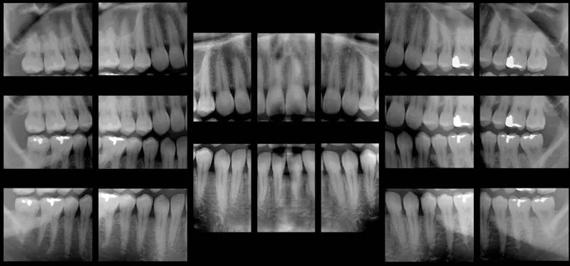 ☢️ FMX Dental X-ray Guide (Are They Safe?)