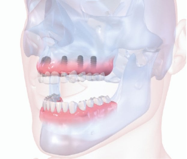 Diagram of full mouth