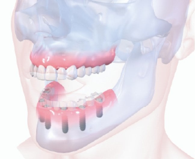 Image of a full mouth in a 3d diagram