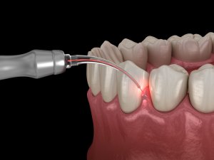 Illustration of a dental laser being used for gum treatment