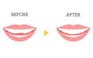 before and after graphic of dental bonding